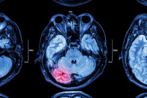 CT scan of TBI traumatic brain injury