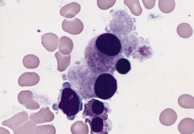 Myelodysplastic Syndromes and agent orange|Myelodysplastic Syndromes Agent Orange