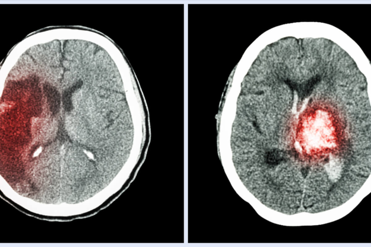 Traumatic Brain Injury Claims