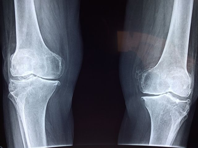 x ray of knees before knee replacement