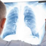 doctor examining x ray for lung disease