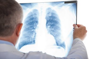 doctor examining x ray for lung disease