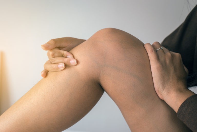 Person touching leg with visible veins due to Thrombophlebitis