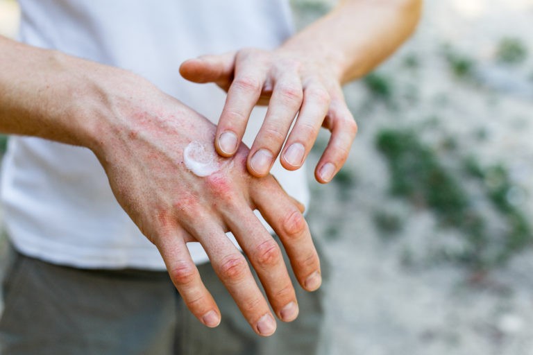 man applying white cream to rash covered hand affected by skin disorder