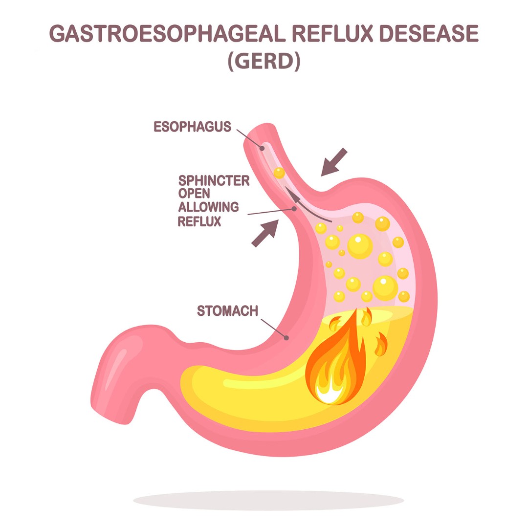 Illustration of how GERD occurs in the stomach