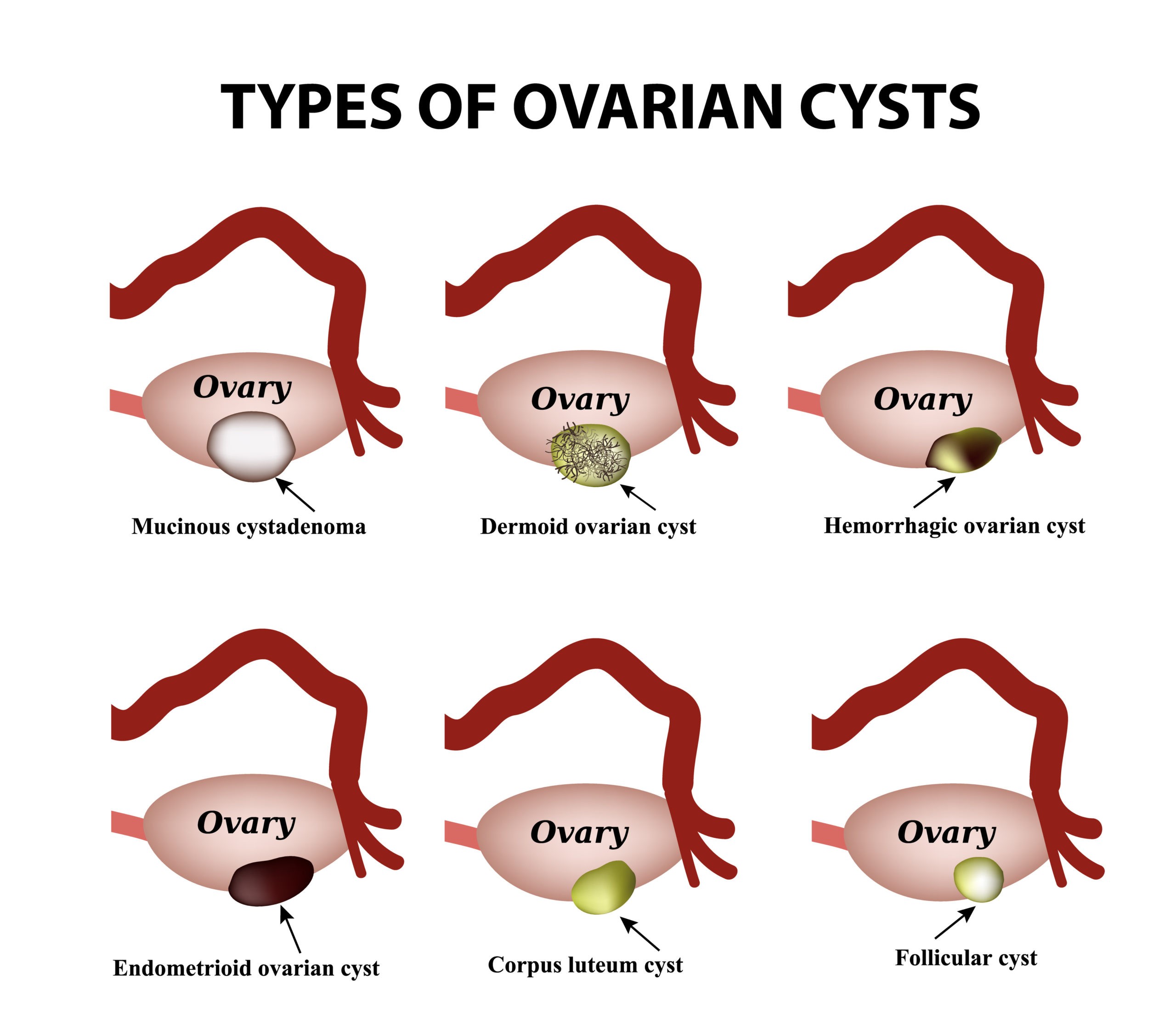Symptoms ovarian cyst Complex Ovarian