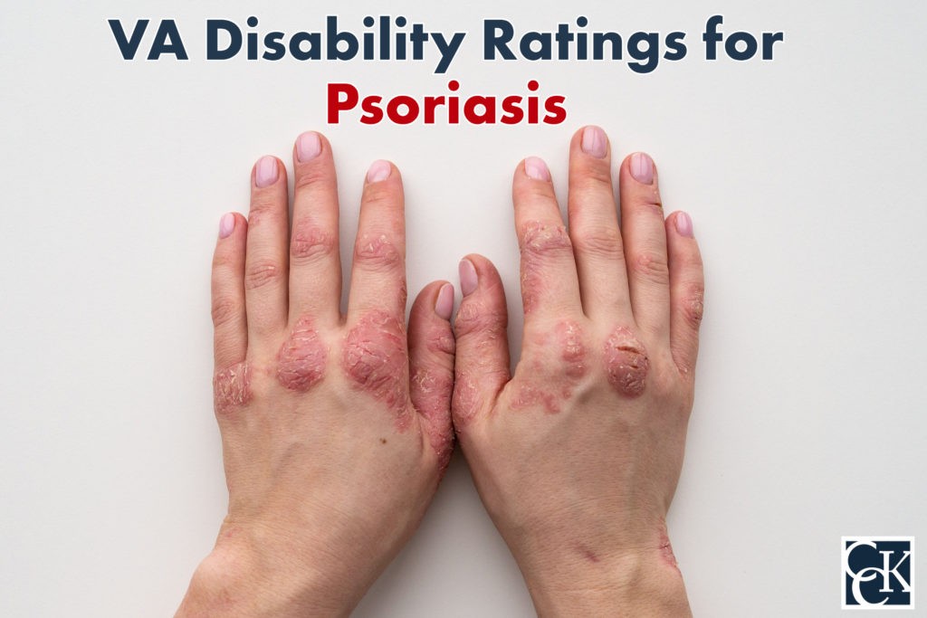 VA Disability Ratings for Psoriasis