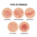 Psoriasis VA Disability Ratings and Benefits Explained | CCK Law