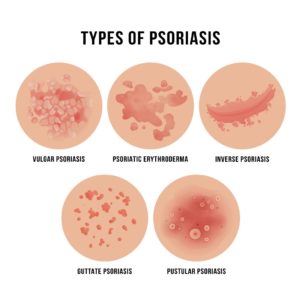 Psoriasis Va Disability Ratings And Benefits Explained 