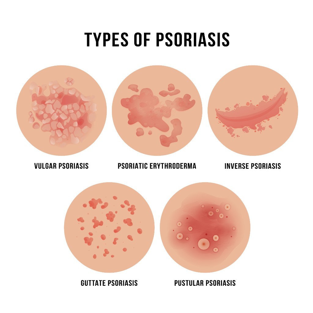 Psoriasis VA Disability Ratings and Benefits Explained CCK Law
