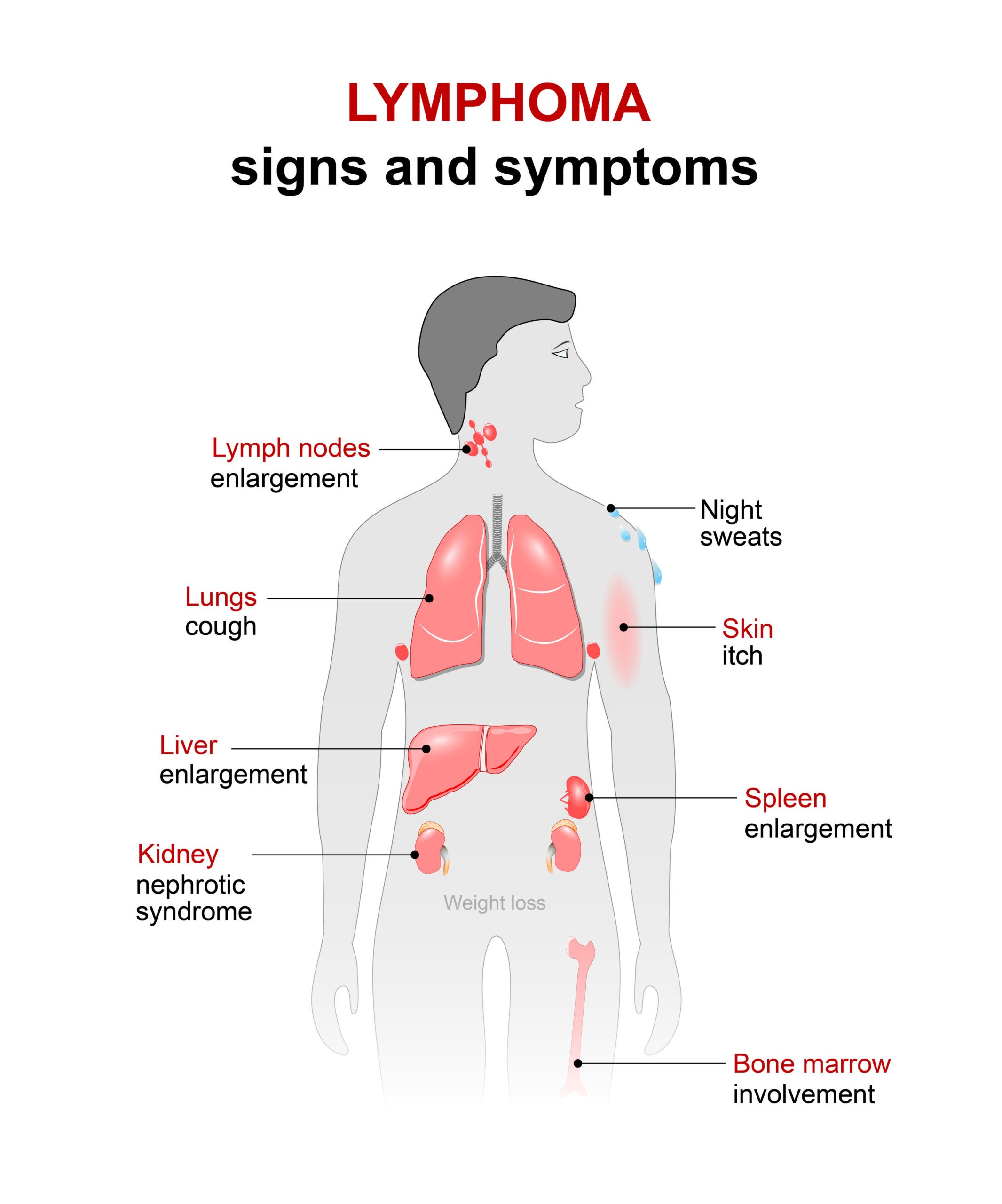 signs and symptoms of lymphoma