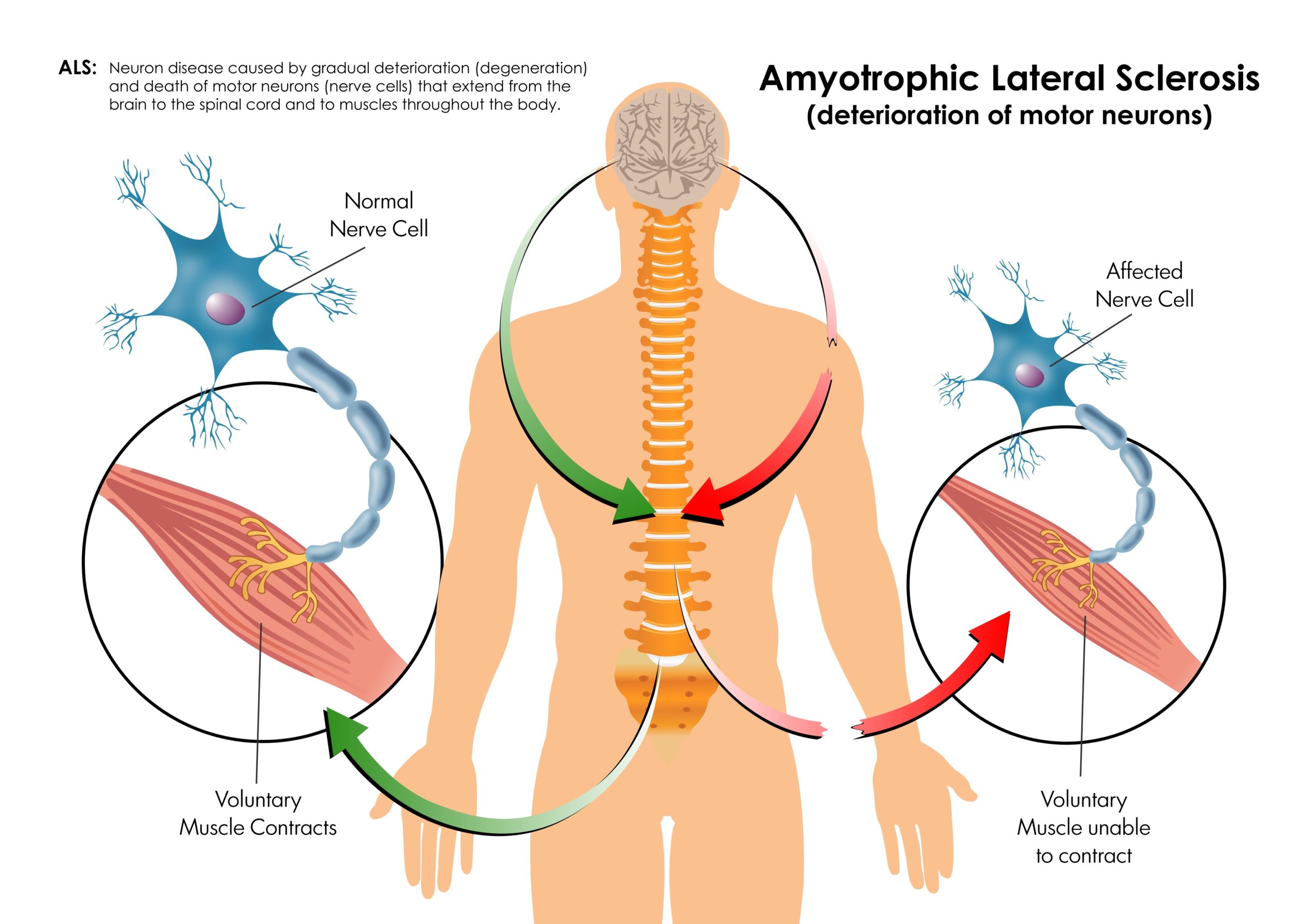 Amyotrophic Lateral Sclerosis ALS is the deterioration of motor neurons that extend from the brain to spinal chord