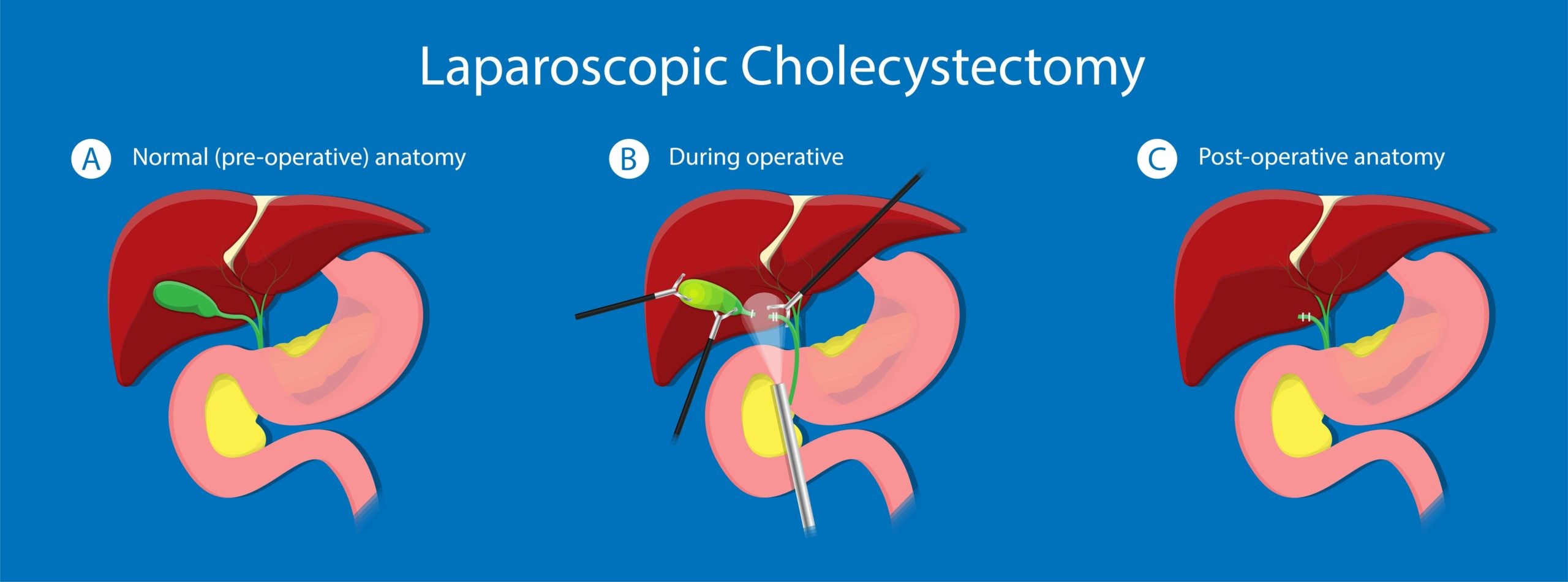 Gallstones cholecystectomy gallbladder removal surgery medical diagram 