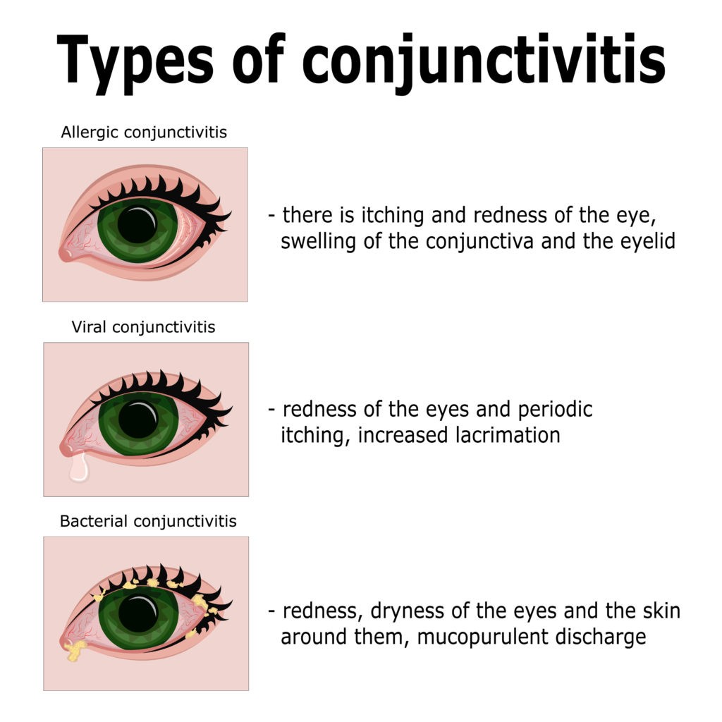 allergic conjunctivitis there is itching and redness of the eye, swelling of the conjunctiva and eyelid; viral conjunctivitis redness of the eyes and periodic itching, increased lacrimation; bacterial conjunctivitis -redness, dryness of the eyes and skin around them, mucopurulent discharge