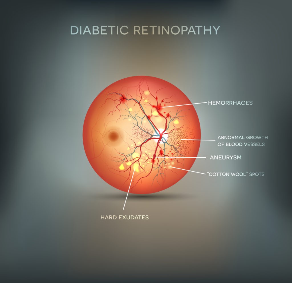 diabetic retinopathy medical diagram of eye: hemorrhages, abnormal growth of blood vessels, aneurism, cotton wool spots, hard exudates are symptoms of diabetic retinopathy 